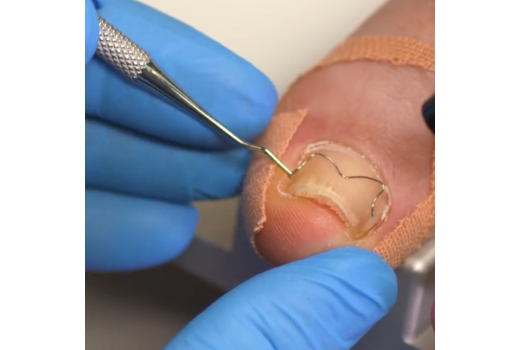 Корекция на деформирани и впити нокти Brace M от AArkada?