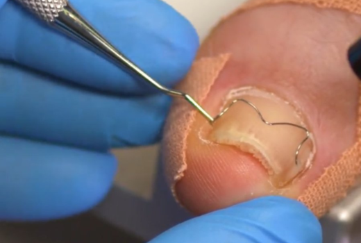 Корекция на деформирани и впити нокти Brace M от AArkada?