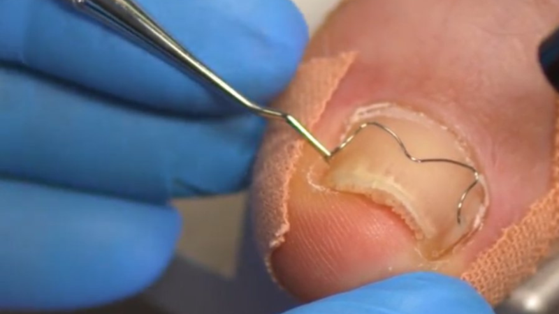 Корекция на деформирани и впити нокти Brace M от AArkada?