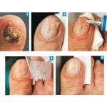 Пластелин за нокти Nagelmasse Gehwol, 15 мл.