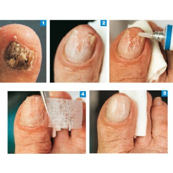 Пластелин за нокти Nagelmasse Gehwol, 15 мл. Пластелин за нокти Nagelmasse Gehwol, 15 мл.