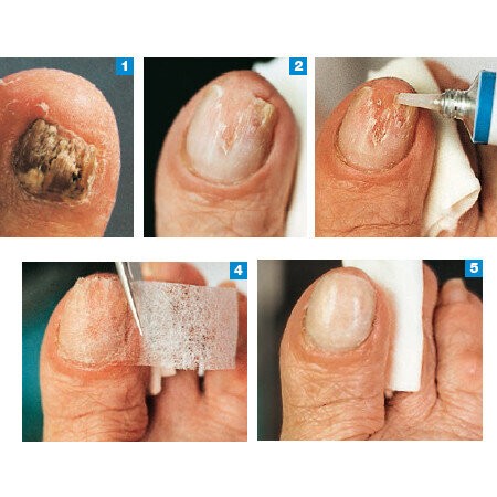 Пластелин за нокти Nagelmasse Gehwol, 15 мл.