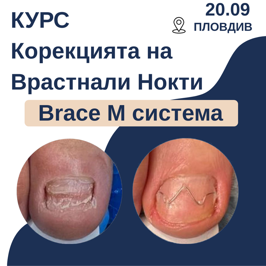 Курс Brace M от Arkada: Майсторство в Корекцията на Врастнали Нокти за Специалисти