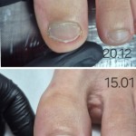 Курс Brace M от Arkada: Майсторство в Корекцията на Врастнали Нокти за Специалисти