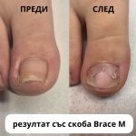 Курс Brace M AArkada. Ефективна корекция на деформирани нокти