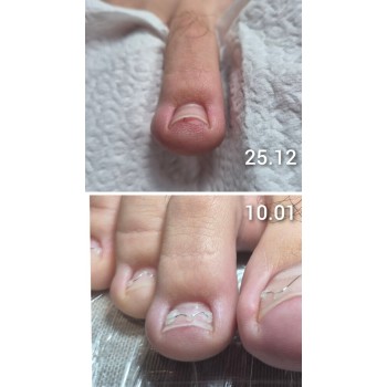 Brace M Arkada инструмент за корекция на враснали нокти на краката