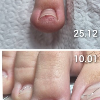 Brace M Arkada инструмент за корекция на враснали нокти на краката