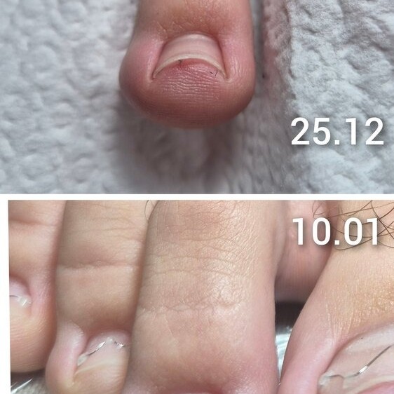 Arkada Sin Brace за корекция на враснали нокти