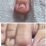 Brace M Set Arkada комплект инструменти за корекция на враснали нокти на краката 